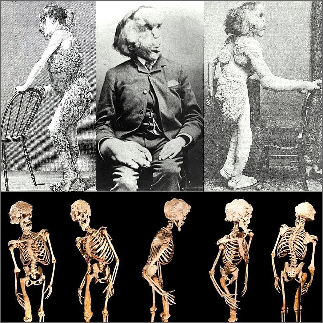 Φωτογραφίες του Τζόζεφ Μέρικ και ανατομικό εκμαγείο του σκελετού του (Μουσείο Βασιλικού Νοσοκομείου του Λονδίνου) 